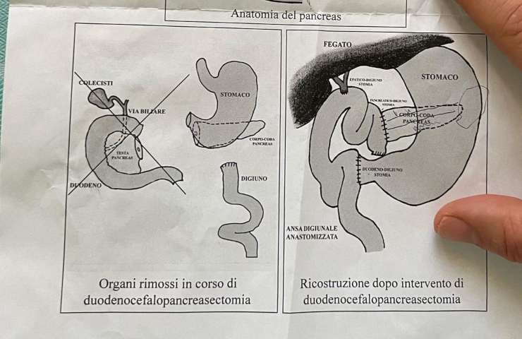 intervento tumore al pancreas