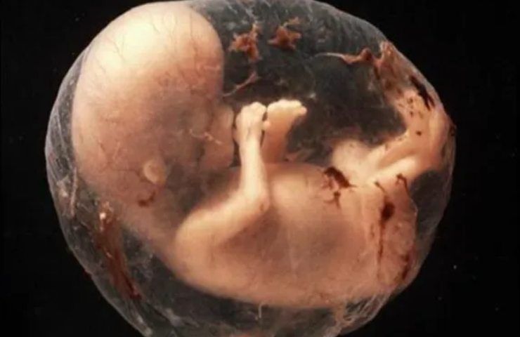 Bimba nasce con 8 embrioni nello stomaco, sembrava un tumore